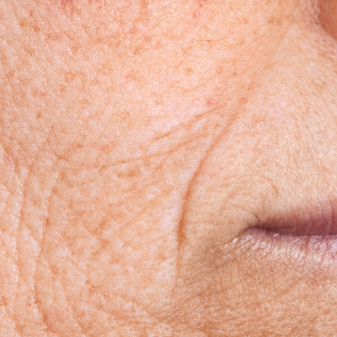 sqre wrinkles
