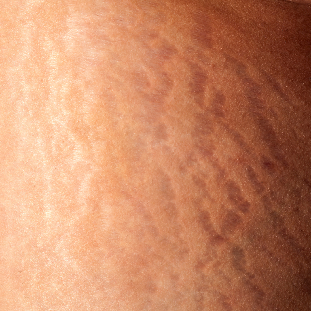 stretch mark square stretch mark square